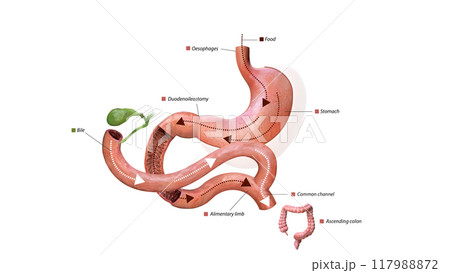 Digestive process after surgery: stomach, food pathway, duodenoileostomy, bile flow, alimentary limb, common channel, and ascending colon, 3d graphic Digestive process after surgery: stomach, food pathway, duodenoileostomy, bile flow, alimentary limb, common channel, and ascending colon, 3d graphic 117988872