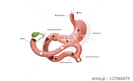 Digestive process after surgery: stomach, food pathway, duodenoileostomy, bile flow, alimentary limb, common channel, and ascending colon, 3d graphic Digestive process after surgery: stomach, food pathway, duodenoileostomy, bile flow, alimentary limb, common channel, and ascending colon, 3d graphic 117988874