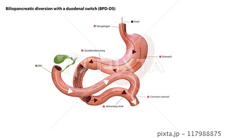 Digestive process after surgery: stomach, food pathway, duodenoileostomy, bile flow, alimentary limb, common channel, and ascending colon, 3d graphic 117988875