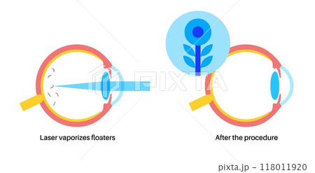 Vitreolysis laser treatment Vitreolysis laser treatment 118011920