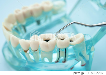 Dentist use dental tool to treatment teeth and gum in patient oral. 118062707