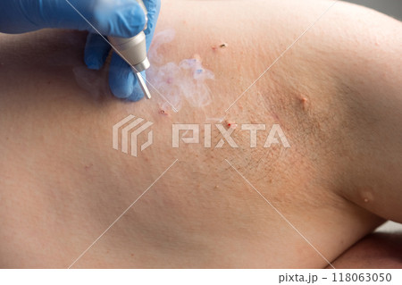 Surgeon is removing papillomas and moles using laser on man body, burning skin. Surgeon is removing papillomas and moles using laser on man body, burning skin. 118063050