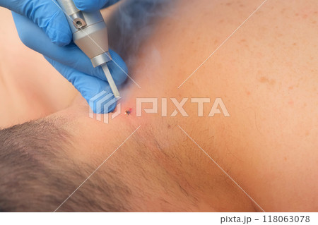 Surgeon removing moles using laser on man's neck, burning skin, closeup view. Surgeon removing moles using laser on man's neck, burning skin, closeup view. 118063078