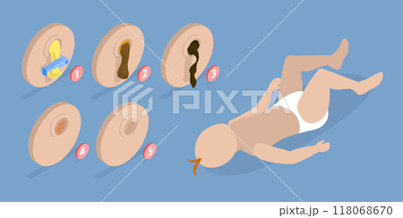 3D Isometric Flat Vector Illustration of Umbilical Cord, After Birth Stages. Swollen, Dry Pus, Scar Tissue, Fall Off 3D Isometric Flat Vector Illustration of Umbilical Cord, After Birth Stages. Swollen, Dry Pus, Scar Tissue, Fall Off 118068670