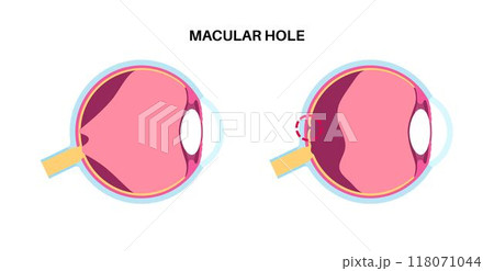 Macular hole disease Macular hole disease 118071044