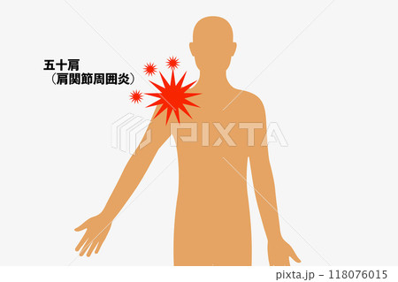 五十肩 五十肩 118076015