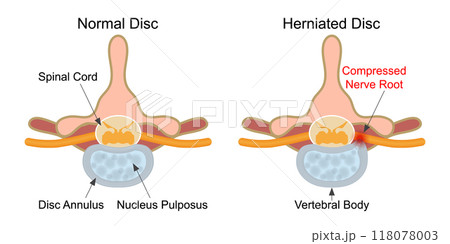 Herniated disc is a fragment of the disc nucleus. Herniated disc is a fragment of the disc nucleus. 118078003