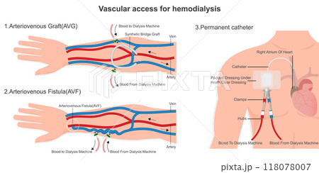Vascular access for hemodialysis. Vascular access for hemodialysis. 118078007