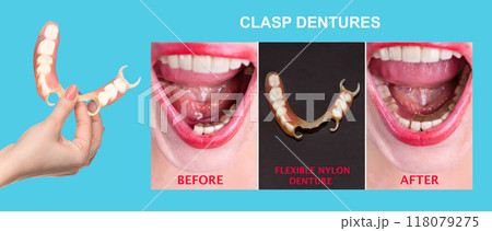 flexible nylon denture on female hand. Removable dentures flexible, devoid of nylon, hypoallergenic exempt from monomer 118079275