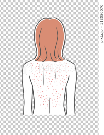 背上皮膚粗糙的女人插畫素材 118086070