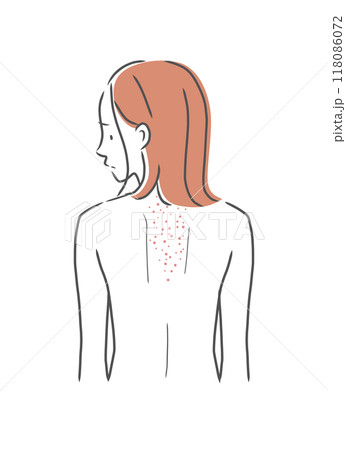 背中が肌荒れしている女性のイラスト素材 背中が肌荒れしている女性のイラスト素材 118086072