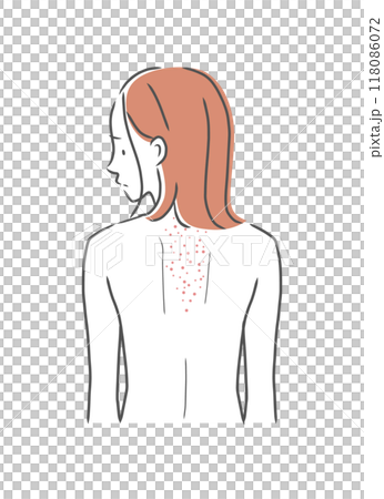 背上皮膚粗糙的女人插畫素材 118086072