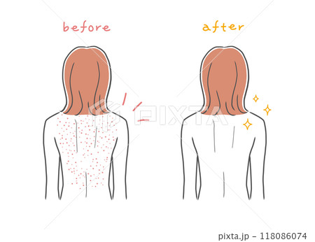 背中が肌荒れしている女性と背中がきれいな女性のイラスト素材 118086074