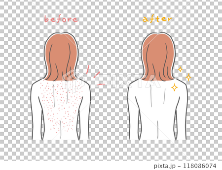 背部皮膚粗糙的女人和背部美麗的女人插畫素材 118086074