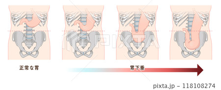 胃下垂、胃、胃アトニー、STAGE OF GASTROPTOSIS 胃下垂、胃、胃アトニー、STAGE OF GASTROPTOSIS 118108274