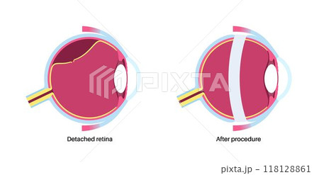 Scleral buckle procedure 118128861