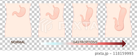 胃下垂、胃、胃アトニー、STAGE OF GASTROPTOSIS 118159993