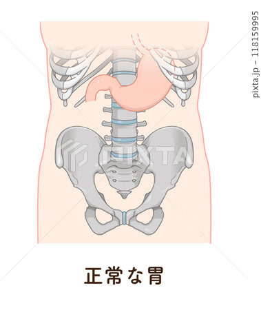 胃下垂、胃、胃アトニー、STAGE OF GASTROPTOSISのイラスト素材