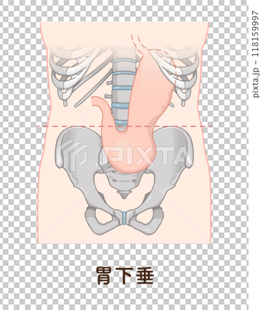Gastroptosis, stomach, gastric atony, STAGE OF GASTROPTOSIS Gastroptosis, stomach, gastric atony, STAGE OF GASTROPTOSIS 118159997