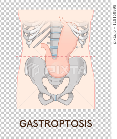 Gastroptosis, stomach, gastric atony, STAGE OF GASTROPTOSIS Gastroptosis, stomach, gastric atony, STAGE OF GASTROPTOSIS 118159998