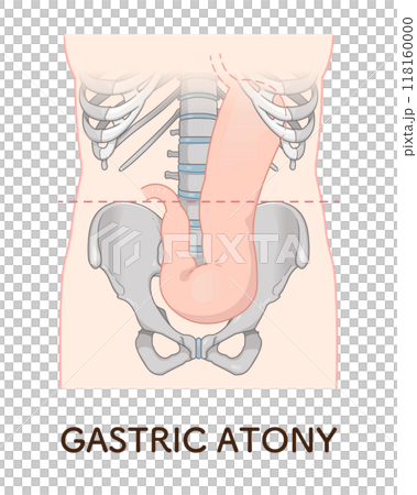 Gastroptosis, stomach, gastric atony, STAGE OF GASTROPTOSIS Gastroptosis, stomach, gastric atony, STAGE OF GASTROPTOSIS 118160000
