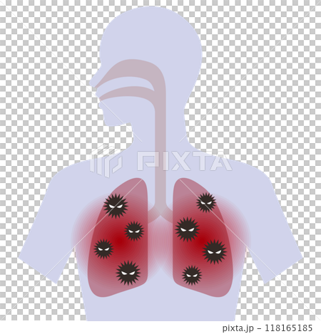 Lung infection 118165185