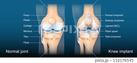 Total knee arthroplasty. Knee joint replacement Total knee arthroplasty. Knee joint replacement 118176545
