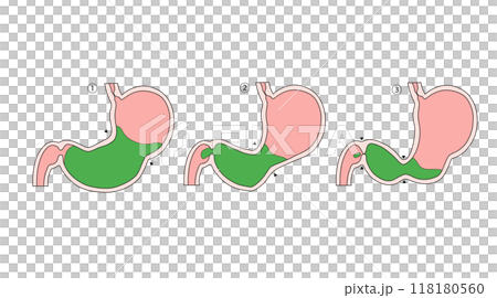 Anatomy and physiology of the digestive system: Peristalsis of the stomach Anatomy and physiology of the digestive system: Peristalsis of the stomach 118180560