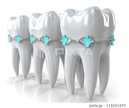 Straightening journey: orthodontic bracket or brace, focusing on dental treatment concept designed to correct misaligned teeth, enhance oral function, boost confidence with beautifully aligned smile. Straightening journey: orthodontic bracket or brace, focusing on dental treatment concept designed to correct misaligned teeth, enhance oral function, boost confidence with beautifully aligned smile. 118201973