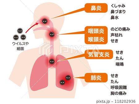 呼吸器感染の場所と病名・症状 118202936