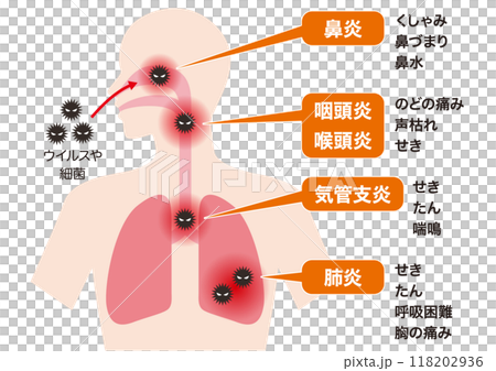 呼吸器感染の場所と病名・症状 118202936
