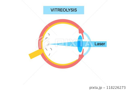 Vitreolysis laser treatment 118226273