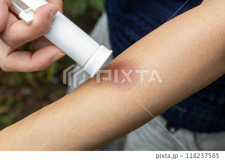 ポイズンリムーバーで虫刺されの毒を吸う女性の手元 118237585