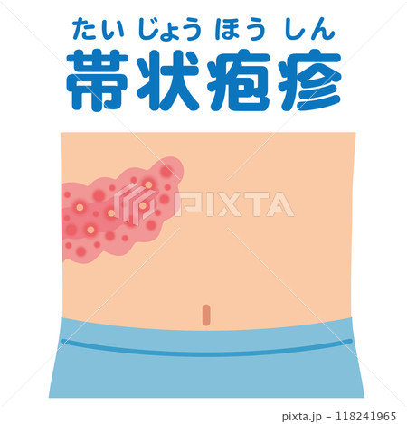 帯状疱疹の症状　医療 118241965