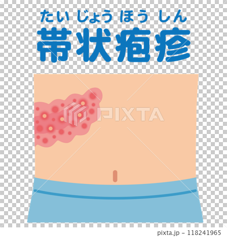 帯状疱疹の症状　医療 118241965