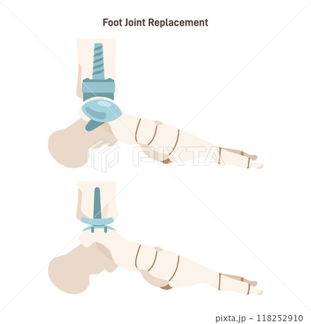 Joint implantation. Injured or distracted human ankle joint replaced with artificial prosthesis made of titanium. Osteoporosis and osteoarthritis treatment surgery. Flat vector illustration 118252910