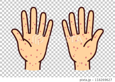 Syphilis skin disease hand illustration material 118269627