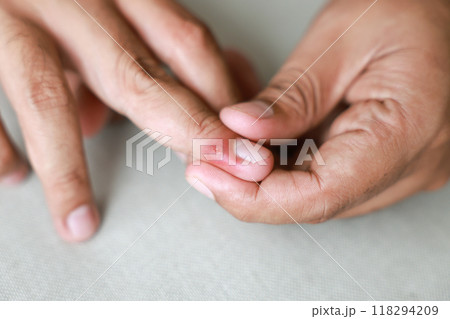 Young man injured his finger and it was swollen and red. Cause of pain include Infected wound. male showing small wound marks on right hand. injured finger. concept of Health care, medical. 118294209