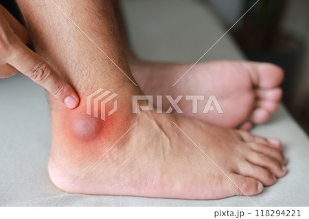 A man injured his ankle and it was swollen and red. Causes of pain include Ankle sprain, Gout, Rheumatoid arthritis, office syndrome, numbness, and cramp symptoms. Healthcare medical concept. 118294221