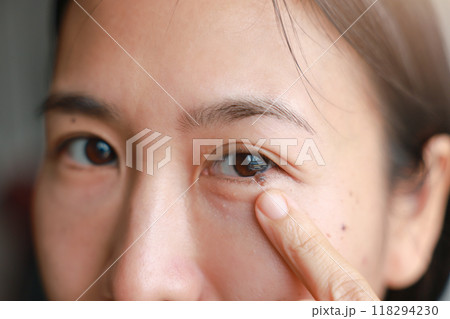 Asian woman pointing at mole on her lower eyelid. concept of Health care, medical, and Beauty. closeup Asian woman pointing at mole on her lower eyelid. concept of Health care, medical, and Beauty. closeup 118294230