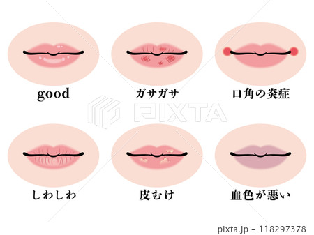 唇のトラブルセット 唇のトラブルセット 118297378