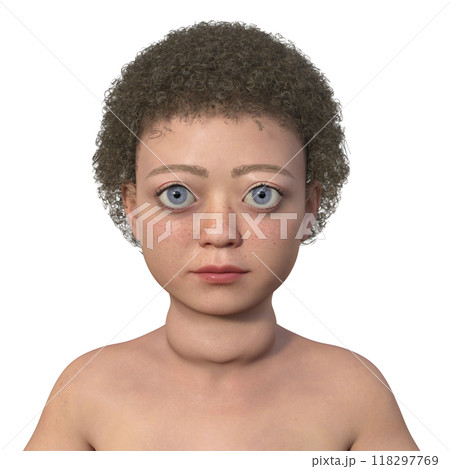 A child with Graves disease, 3D illustration 118297769