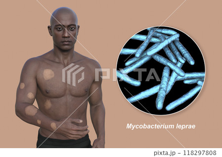 Tuberculoid leprosy, 3D illustration 118297808