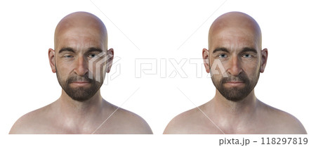A man with ptosis, 3D illustration 118297819