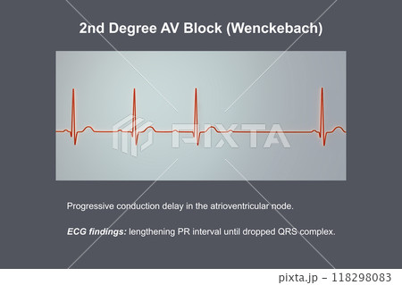 ECG of 2nd degree AV block Wenckebach , 3D illustration ECG of 2nd degree AV block Wenckebach , 3D illustration 118298083