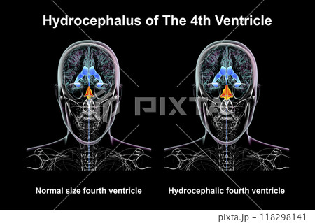 Enlargement of the fourth brain ventricle, 3D illustration Enlargement of the fourth brain ventricle, 3D illustration 118298141