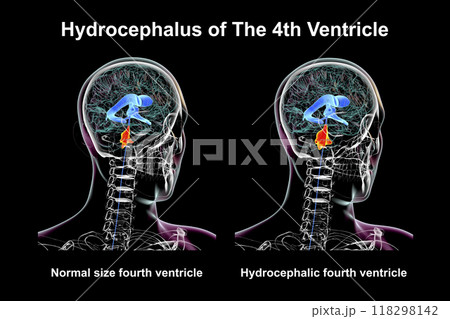 Enlargement of the fourth brain ventricle, 3D illustration Enlargement of the fourth brain ventricle, 3D illustration 118298142