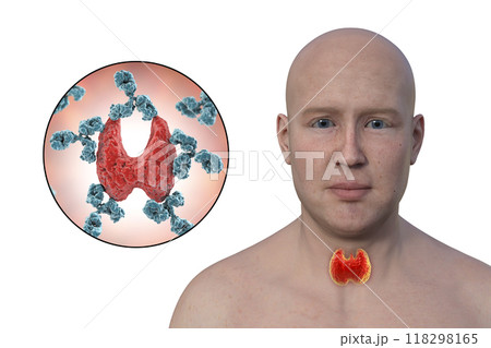 Hashimoto's thyroiditis, conceptual 3D illustration 118298165