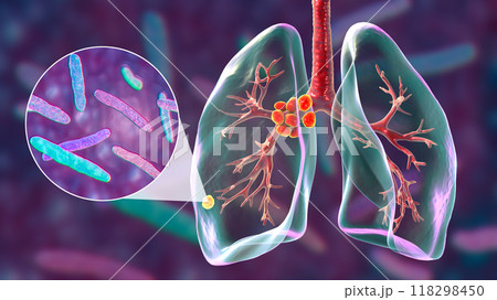 Primary lung tuberculosis, 3D illustration 118298450