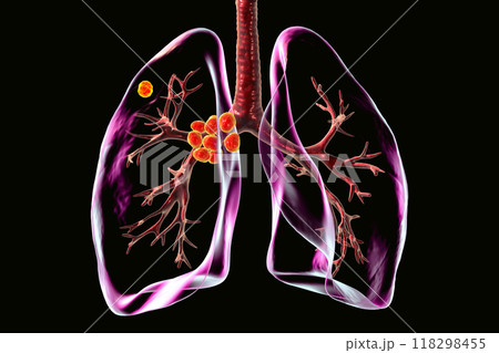 Primary lung tuberculosis, 3D illustration Primary lung tuberculosis, 3D illustration 118298455